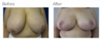 Breast Reduction Los Angeles with Dr. Kenneth Hughes