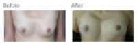 Breast Augmentation and Fat Grafting Los Angeles with Dr. Kenneth Hughes