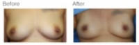 Breast Augmentation and Fat Grafting Los Angeles with Dr. Kenneth Hughes