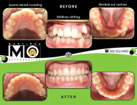 Braces: Before and After photos