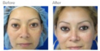 Eyelid Surgery Los Angeles with Dr. Kenneth Hughes
