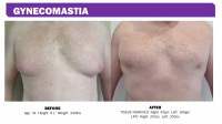 Front View Before and After Gynecomastia Actual Patient