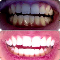 Teeth Whitening