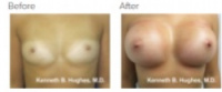 Breast Augmentation (Implants) Los Angeles with Dr. Kenneth Hughes