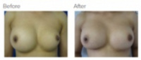 Breast Reconstruction and Breast Deformity Correction Los Angeles with Dr. Kenneth Hughes
