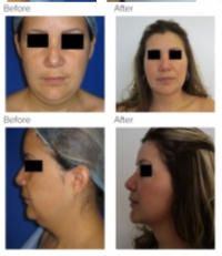 Chin Liposuction Los Angeles with Dr. Kenneth Hughes