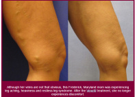 Varicose Veins before and after treatment.  Covered by insurance.