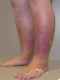 Evaluation, diagnostics and management of lymphedema and swollen legs