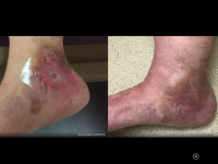 Healing of venous stasis ulceration after varicose vein ablation