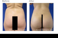 Liposuction 360 and BBL with Dr. Kenneth Hughes Liposuction 360 and BBL with Dr. Kenneth Hughes