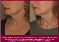Facial vein before and after one sclerotherapy treatment
