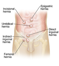 hernia repair
