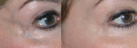 Eye vein: before and after treatment