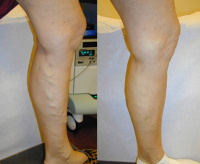 Varicose Veins Before and after treatment.