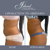Liposuction to Abdomen