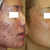Treatment for acne and acne scaring