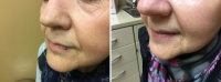 Venous lake - before and after Excel Genesis Laser treatment