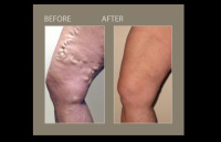 Varicose Vein evaluation, diagnostics and treatments.  No down time.  Covered by insurance.