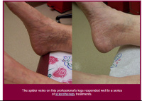 Ankle spider veins before and after sclerotherapy treatment.