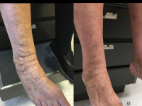 Foot / ankle veins before and after treatment.  Covered by insurance
