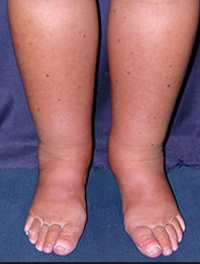 Evaluation, diagnostices and therapy for lymphedema and leg swelling