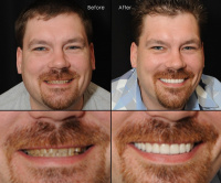 Full Mouth Rehabilitation 6