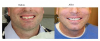 Porcelain Veneers - Before & After 11