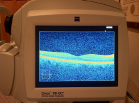 Optical Coherence Tomography 6