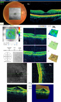 SD-OCT high tech eye exam to diagnose and treat macular degeneration. VSP eye doctor, VSP eye exam 3