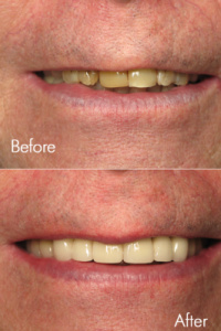 Smile Makeovers 4