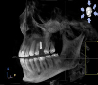 Galileos 3D CT Scan is used not only for screening, but for fabricating implant surgical guides. 5