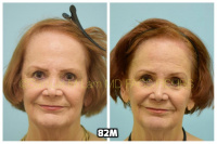 This 76-year-old woman is shown before and after using 82M for her hair loss.   2