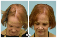 This 76-year-old woman is shown before and after using 82M for her hair loss.   2
