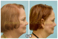 This 76-year-old woman is shown before and after using 82M for her hair loss.   3