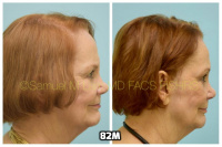 This 76-year-old woman is shown before and after using 82M for her hair loss.   4