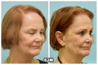This 76-year-old woman is shown before and after using 82M for her hair loss.   4