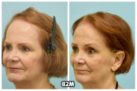 This 76-year-old woman is shown before and after using 82M for her hair loss.   5