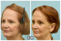 This 76-year-old woman is shown before and after using 82M for her hair loss.   6