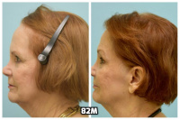 This 76-year-old woman is shown before and after using 82M for her hair loss.   7