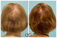 This 76-year-old woman is shown before and after using 82M for her hair loss.   8