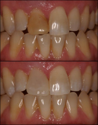 Before and After 1 3