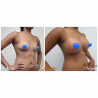 Breast Augmentation  4