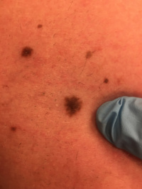 early melanoma, get your moles checked. 1