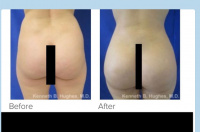 Liposuction and Brazilian buttlift with Dr. Kenneth Benjamin Hughes 50