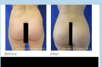 Liposuction and Brazilian buttlift with Dr. Kenneth Benjamin Hughes 3