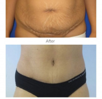 Tummy Tuck with Dr. Kenneth Benjamin Hughes 55