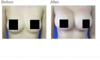 Breast Augmentation with Implants or Fat Transfer with Dr. Kenneth Benjamin Hughes 60