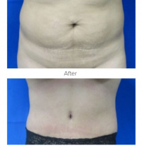 Tummy Tuck with Dr. Kenneth Benjamin Hughes in Los Angeles 65