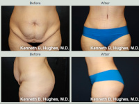Mommy Makeover with Tummy Tuck with Dr. Kenneth Benjamin Hughes in Los Angeles  143