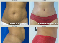 Tummy Tuck with Dr. Kenneth Benjamin Hughes in Los Angeles 10